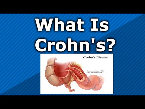 What is Crohn s Disease